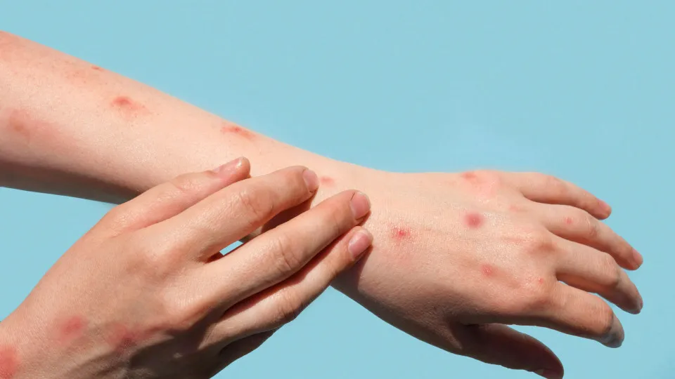 Brasil confirma 48 casos de mpox em 2026