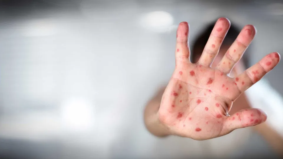 Sarampo pode causar “amnésia imunológica” após infecção